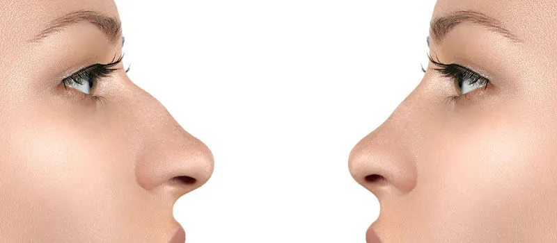 Rinomodelación: Tecnología Avanzada en la Estética Facial